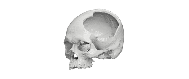 Neurosurgery Skull Model