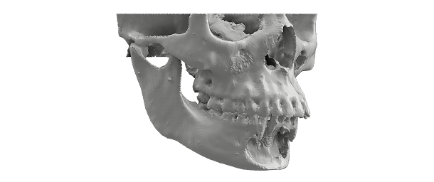Maxillofacial 3D Model