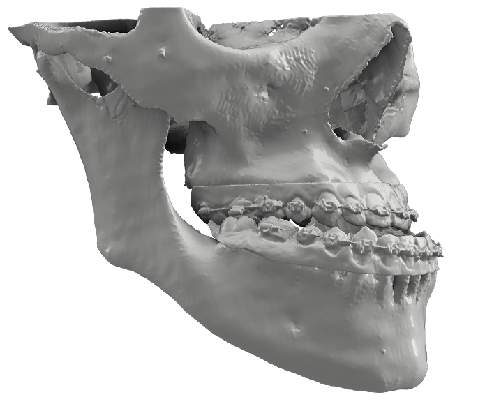 3D Printed Jaw Model for Medical Applications