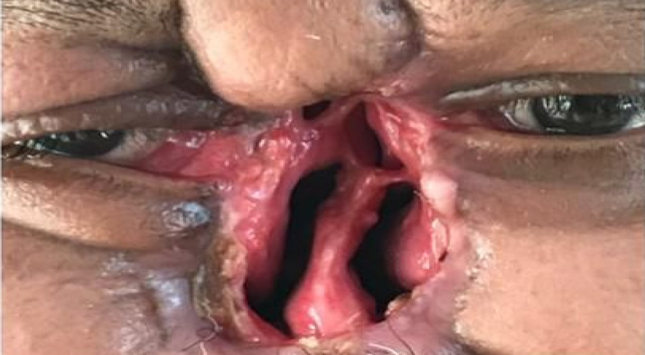 Patient before artificial nasal prosthesis