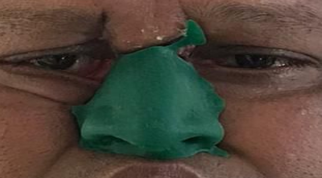 Patient with fitted nasal prosthesis