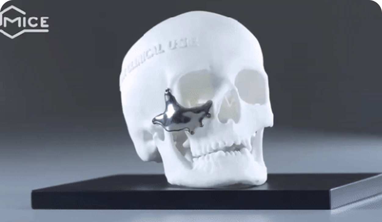 Patient-Specific Implant Package