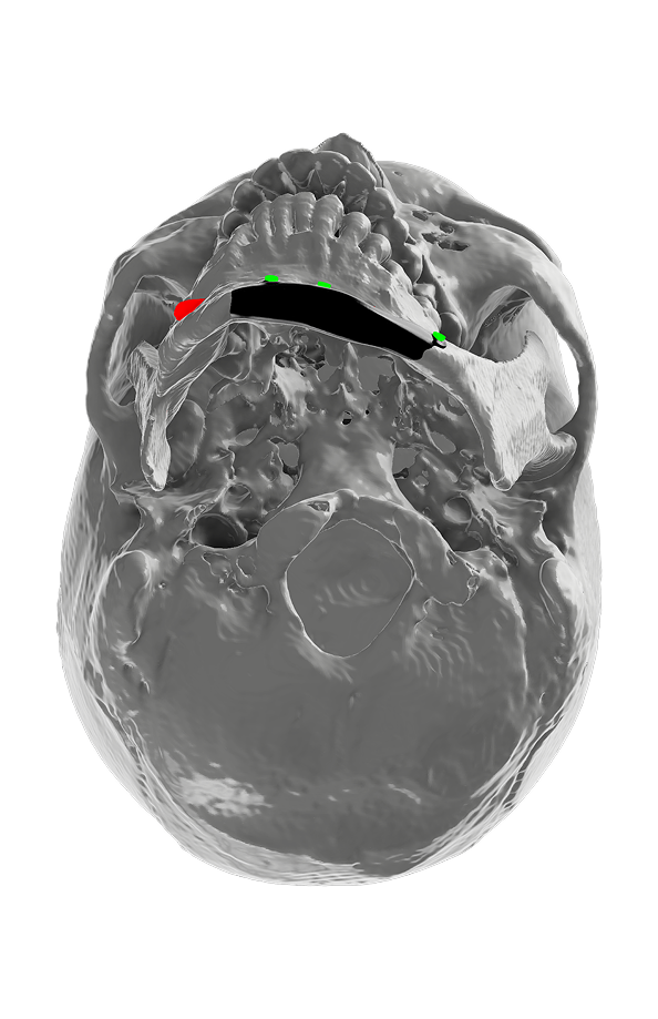 Virtual Surgical Planning