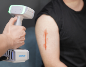 3D Scanning of Facial Prosthesis