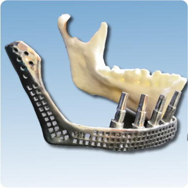 Patient Specific Implant