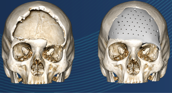 3D printed cranial models