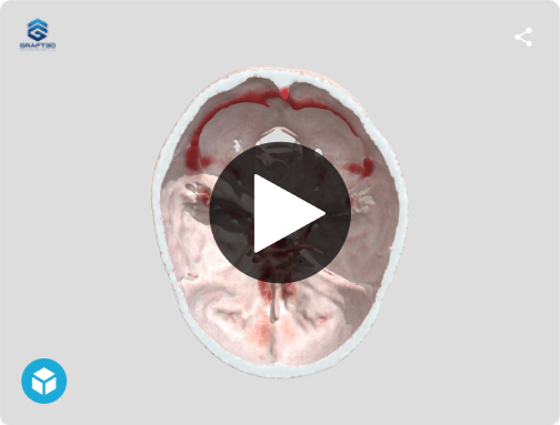Basilar Tip Aneurysm 3D model preview