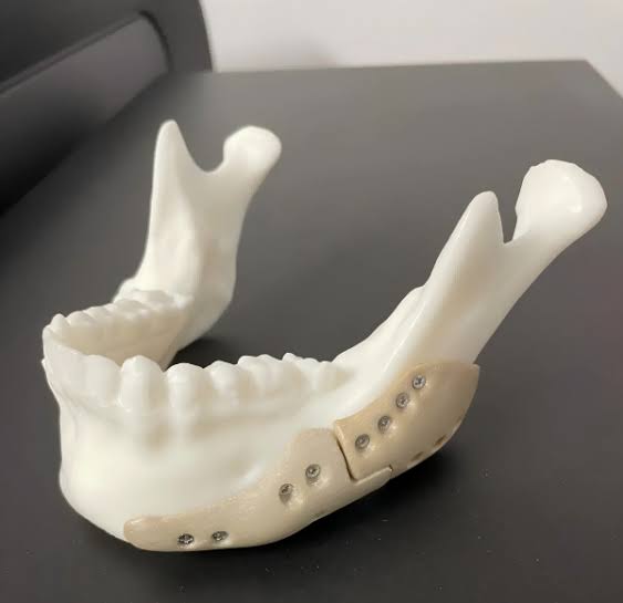 Patient Specific Implant Precision