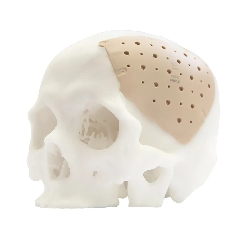 Patient Specific Implant Design