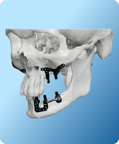 Overview of patient specific implants for maxilla and mandible