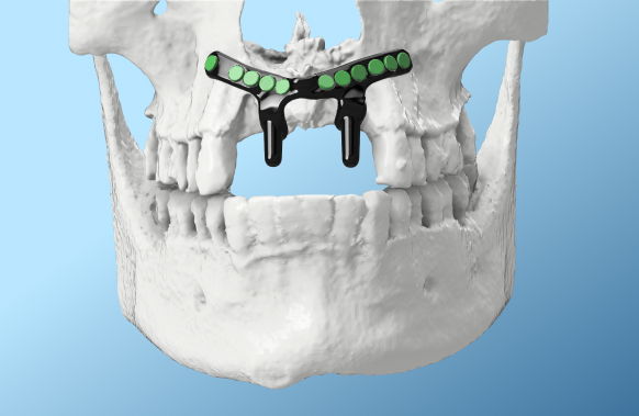 Armamentarium for patient specific implants