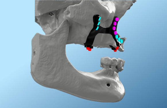 Better Adaptation in Defect Reconstruction