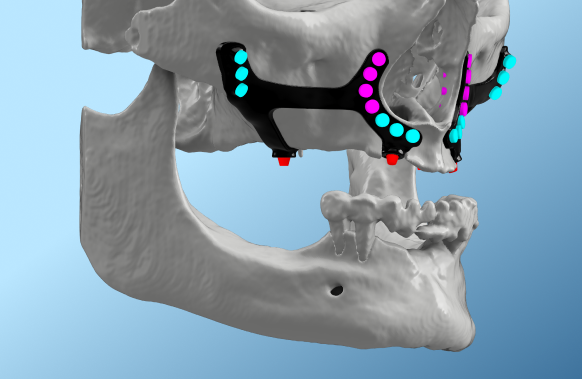 3D visualisation of patient specific implant