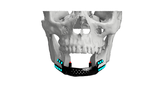 Trauma Reconstruction PSI