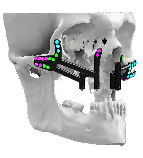 Advantages of 3D-Printed Patient-Specific Implants
