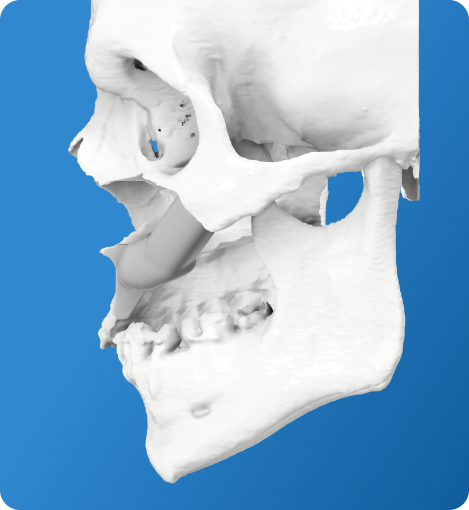 Pre Planned Dental Implants