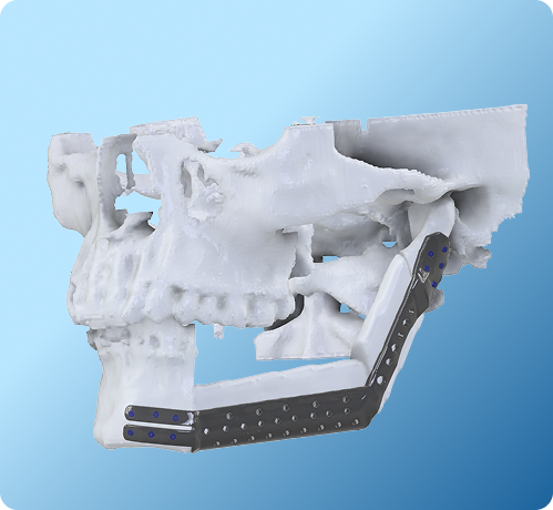 Maxilla & Mandible Reconstruction | Graft3D