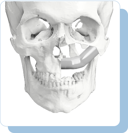 Maxilla & Mandible Reconstruction | Graft3D