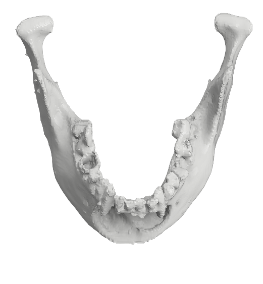 Mandible Reconstruction