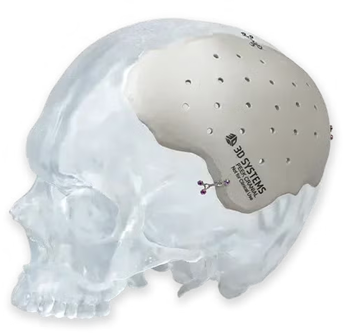 PEEK implant on transparent skull model