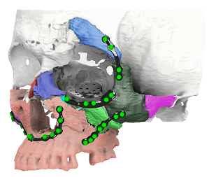 Regraft PFT - Virtual Surgical Planning & Plates for Facial Trauma