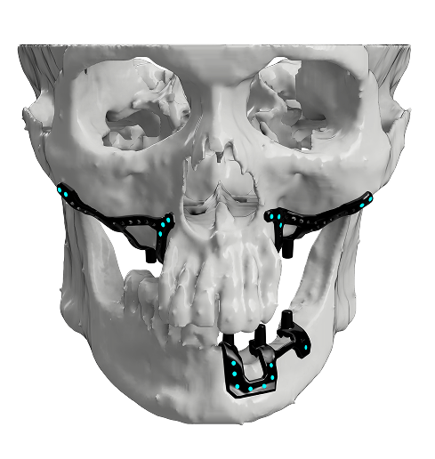 PSI for Atrophic Maxilla and Mandible