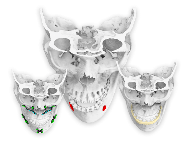 (VSP) Plates in Orthognathic Surgery