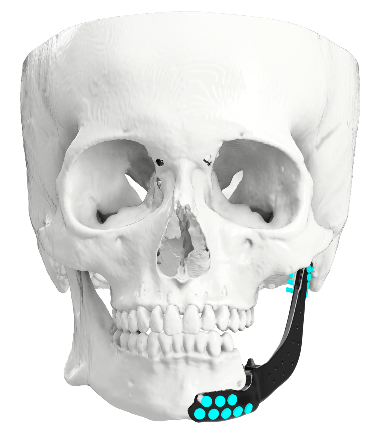 Resected Mandible and Maxilla