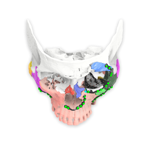 Plates for Facial Trauma