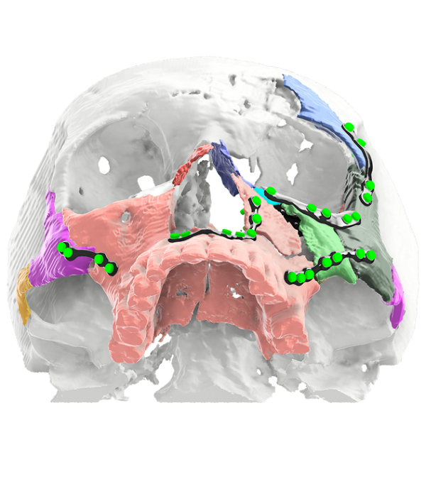 Advantages of Virtual Surgical Planning