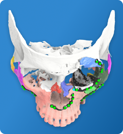 Virtual Surgical Planning Model