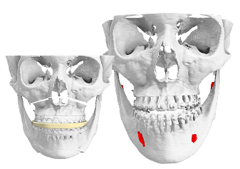 Patient Specific Surgical Guides