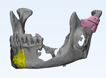 Figure 1 mandible defect resection guides