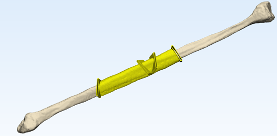 Figure 4 fibula cutting guide