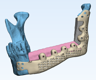 Figure 5 patient-specific implant with fibula fragments