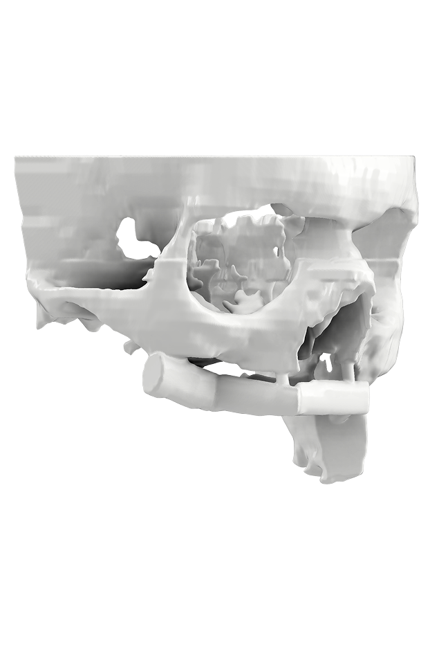 Clinical Applications of 3D Printed Facial Bone Augmentation