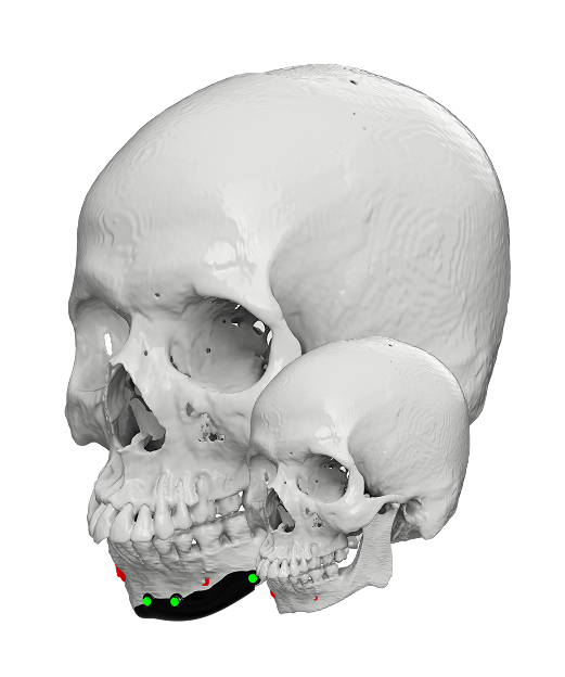 Facial Bone Augmentation 3D Model