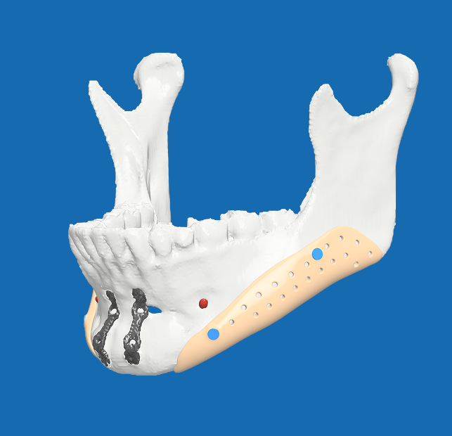 Mandible with Implant