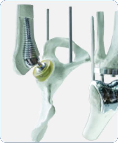 Orthopedic Implants & Fixation Devices