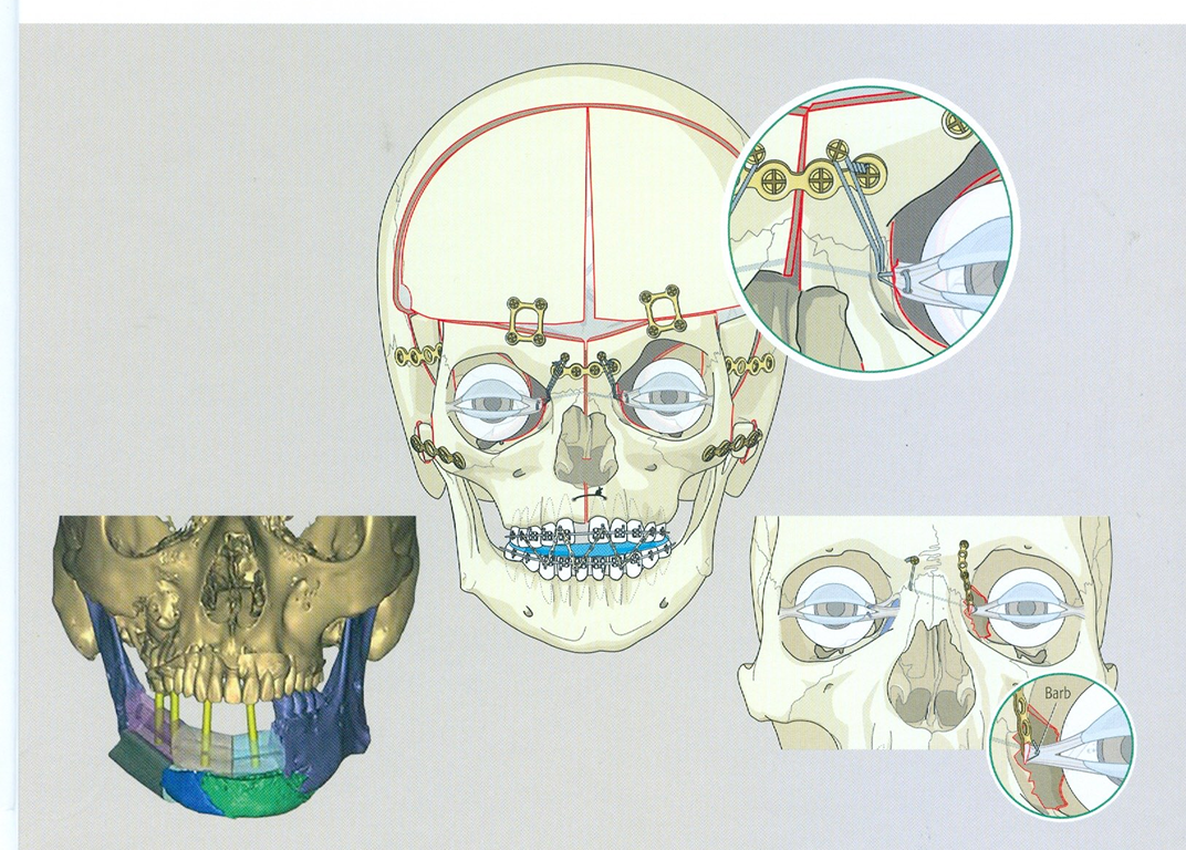 Cranio-Maxillofacial Surgery