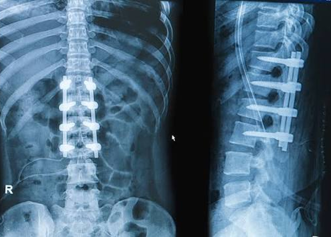 Spine Surgery