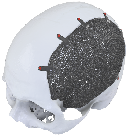 Cranial Vault Reconstruction