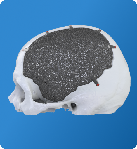 Cranial Vault Reconstruction Quote