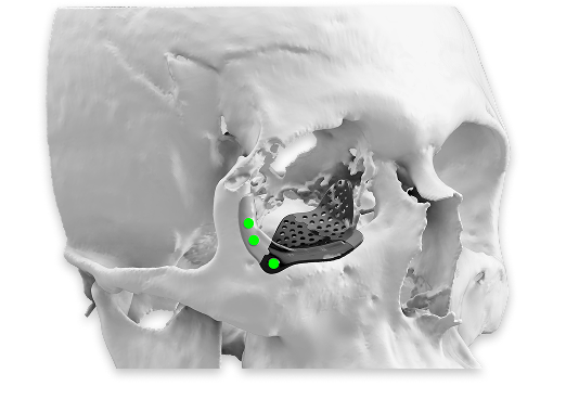 Benefits Of 3D Printing Orbital Surgery