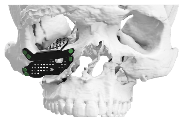 Polyetheretherketone PEEK