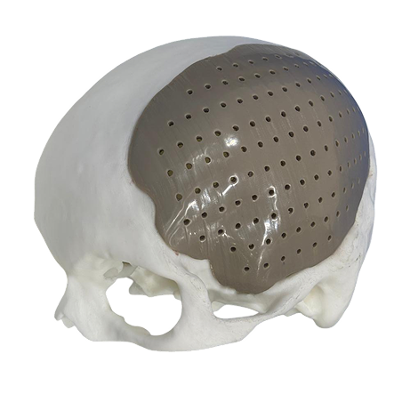 Anatomical skull model with custom PEEK implant