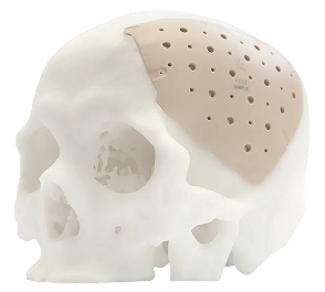 ArtiBone skull with PEEK implant