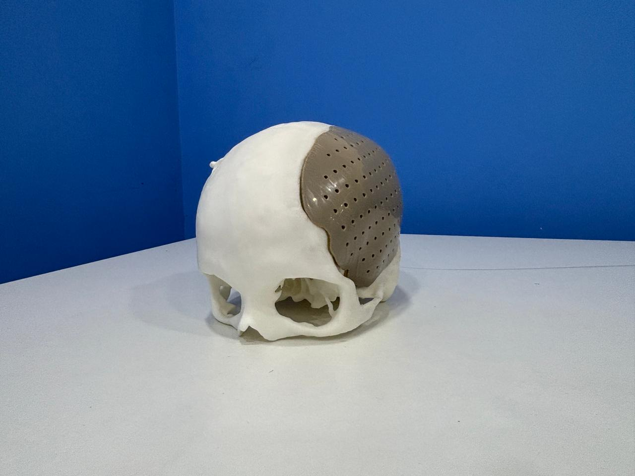 After surgery — custom PEEK implant in place