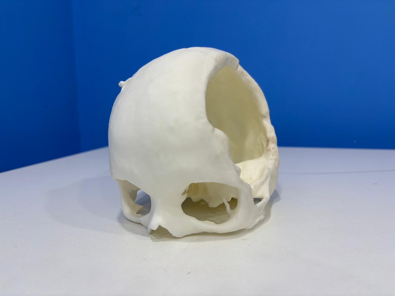 Before surgery — skull with cranial defect
