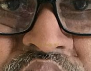 Facial prosthesis treatment progression collage